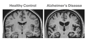 MRI-scan-of-brain