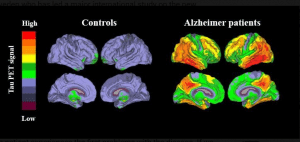 PET-scan-image-of-brain