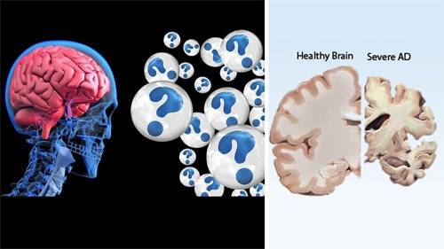 alzheimers-disease-recent-advances