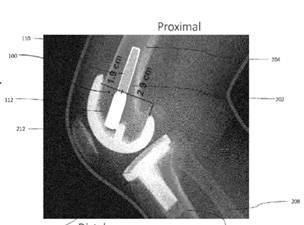 implantable-knee-sensor