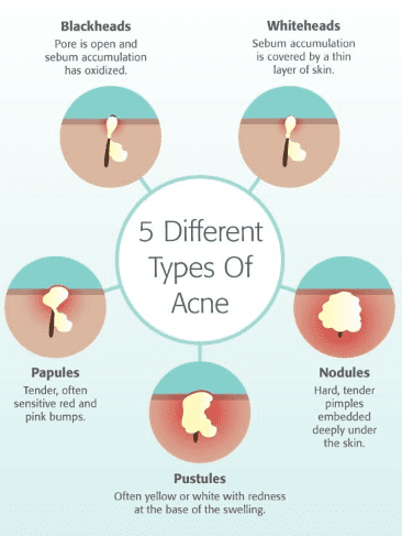 Types-of-acne-based-on-severity-of-lesions