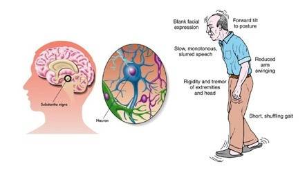 Parkinson’s Disease – Recent Advances